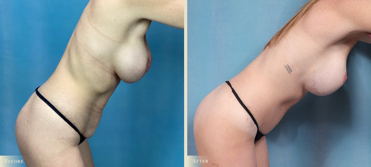 Mommy Makeover Before & After Gallery - Patient 316819 - Image 3