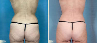 Mommy Makeover Before & After Gallery - Patient 316819 - Image 4