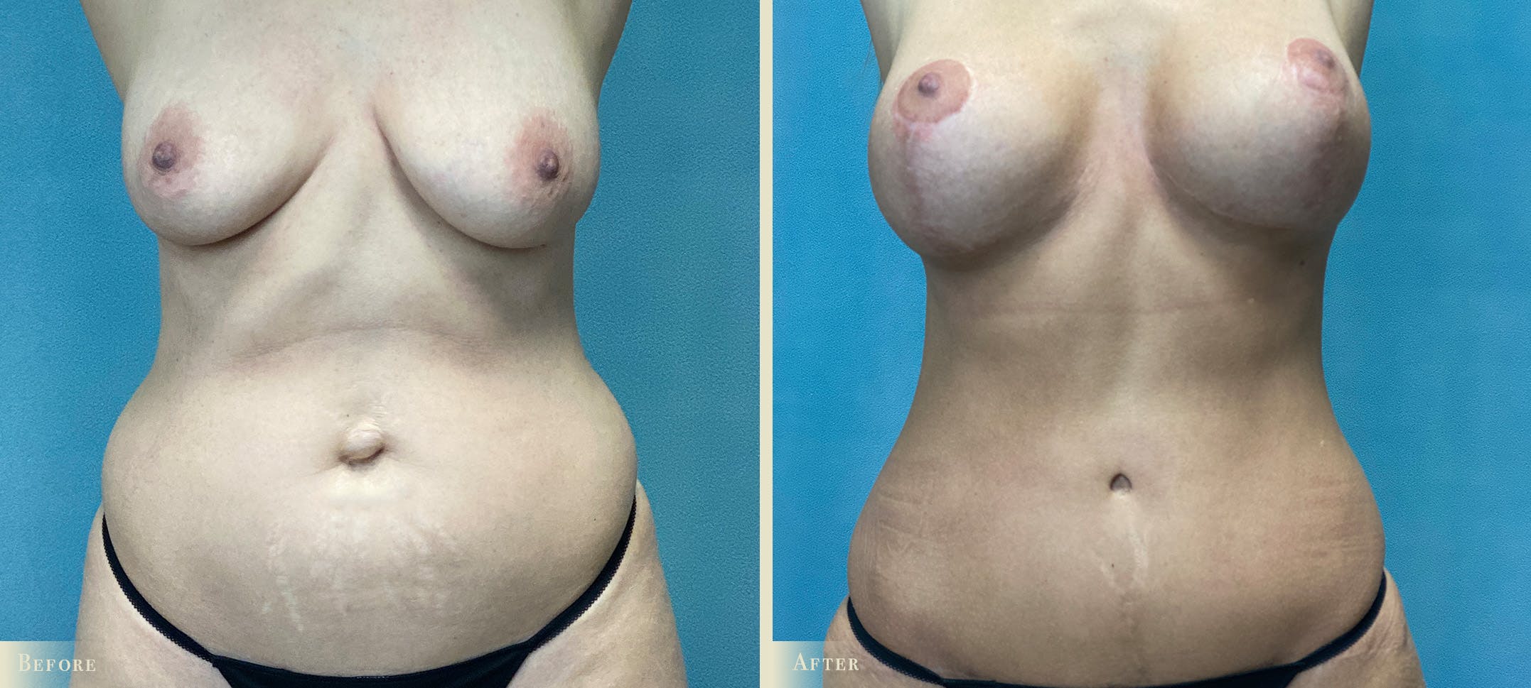 Tummy Tuck Before & After Gallery - Patient 206474 - Image 1