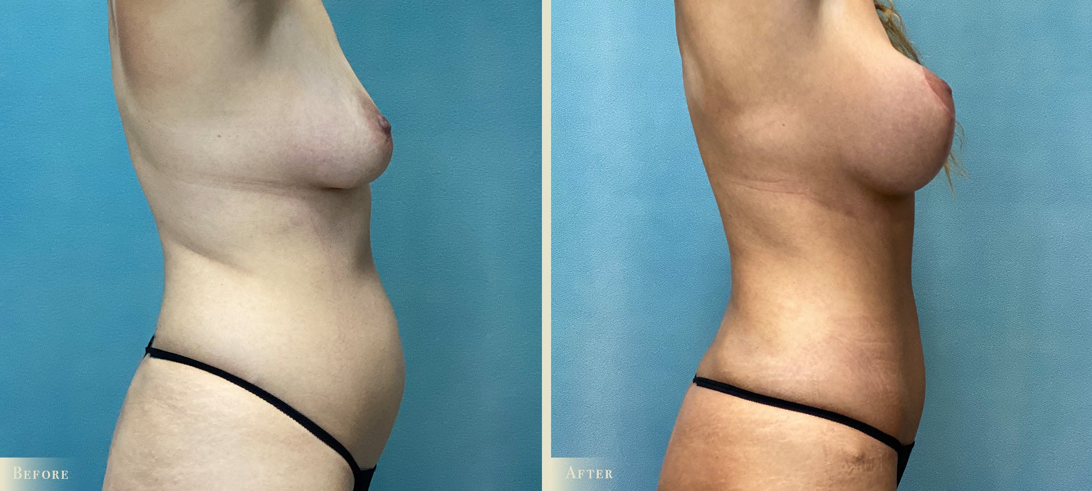 Tummy Tuck Before & After Gallery - Patient 206474 - Image 2