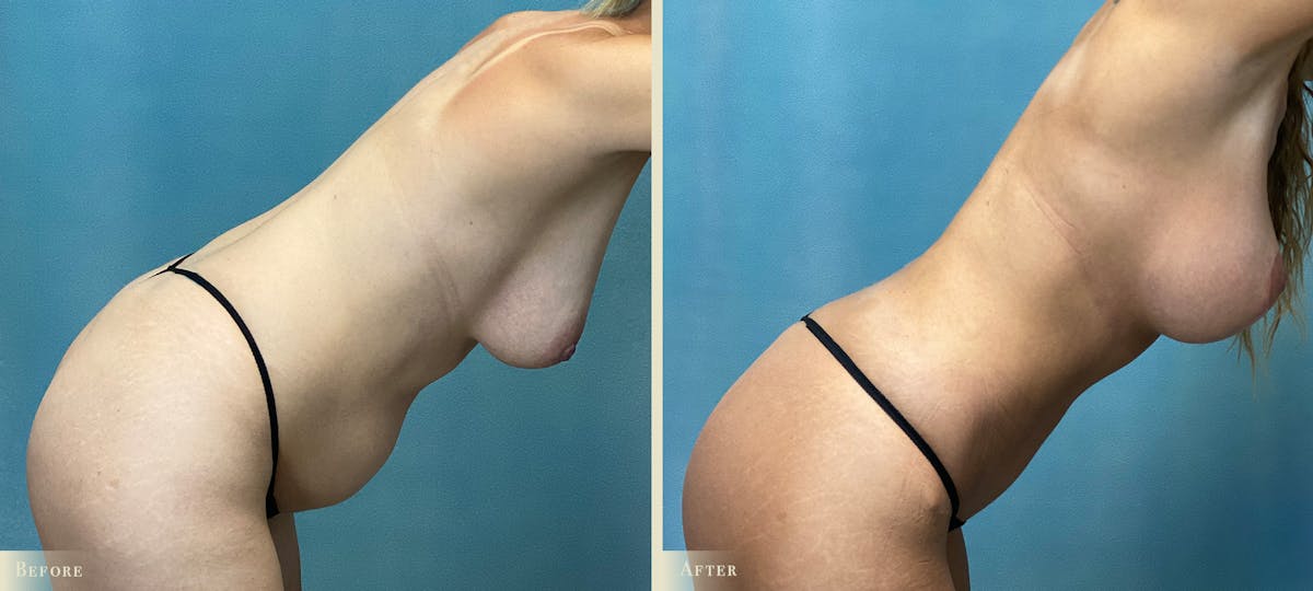 Mommy Makeover Before & After Gallery - Patient 354786 - Image 3
