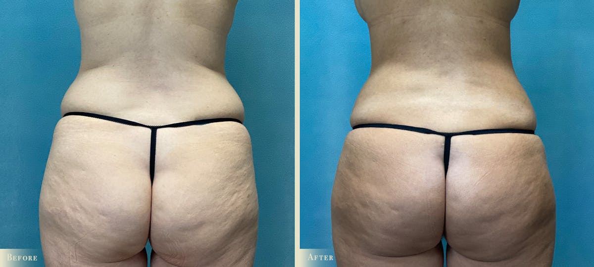 Mommy Makeover Before & After Gallery - Patient 354786 - Image 4