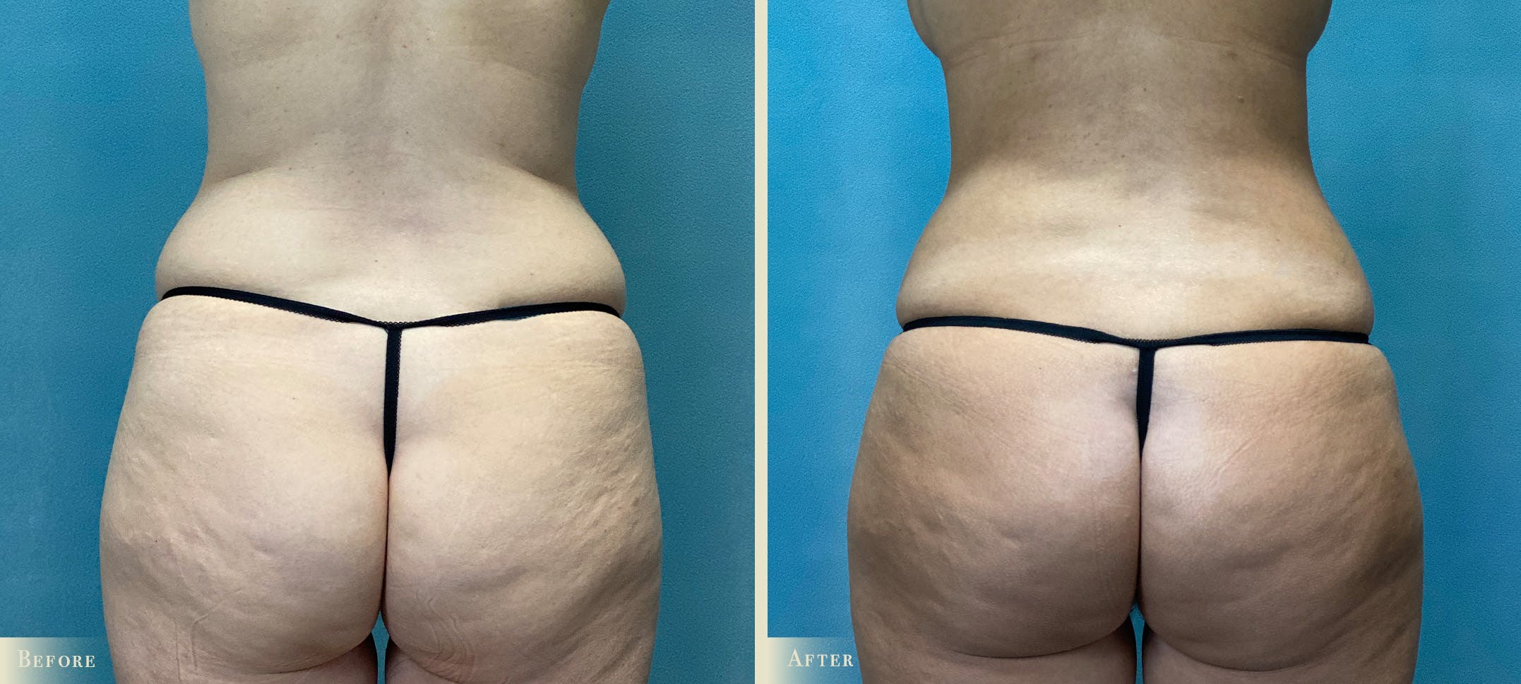 Tummy Tuck Before & After Gallery - Patient 206474 - Image 4