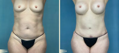 Female Liposuction Before & After Gallery - Patient 597297 - Image 1