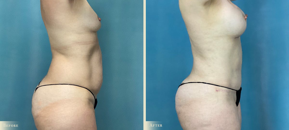 Mommy Makeover Before & After Gallery - Patient 285590 - Image 2