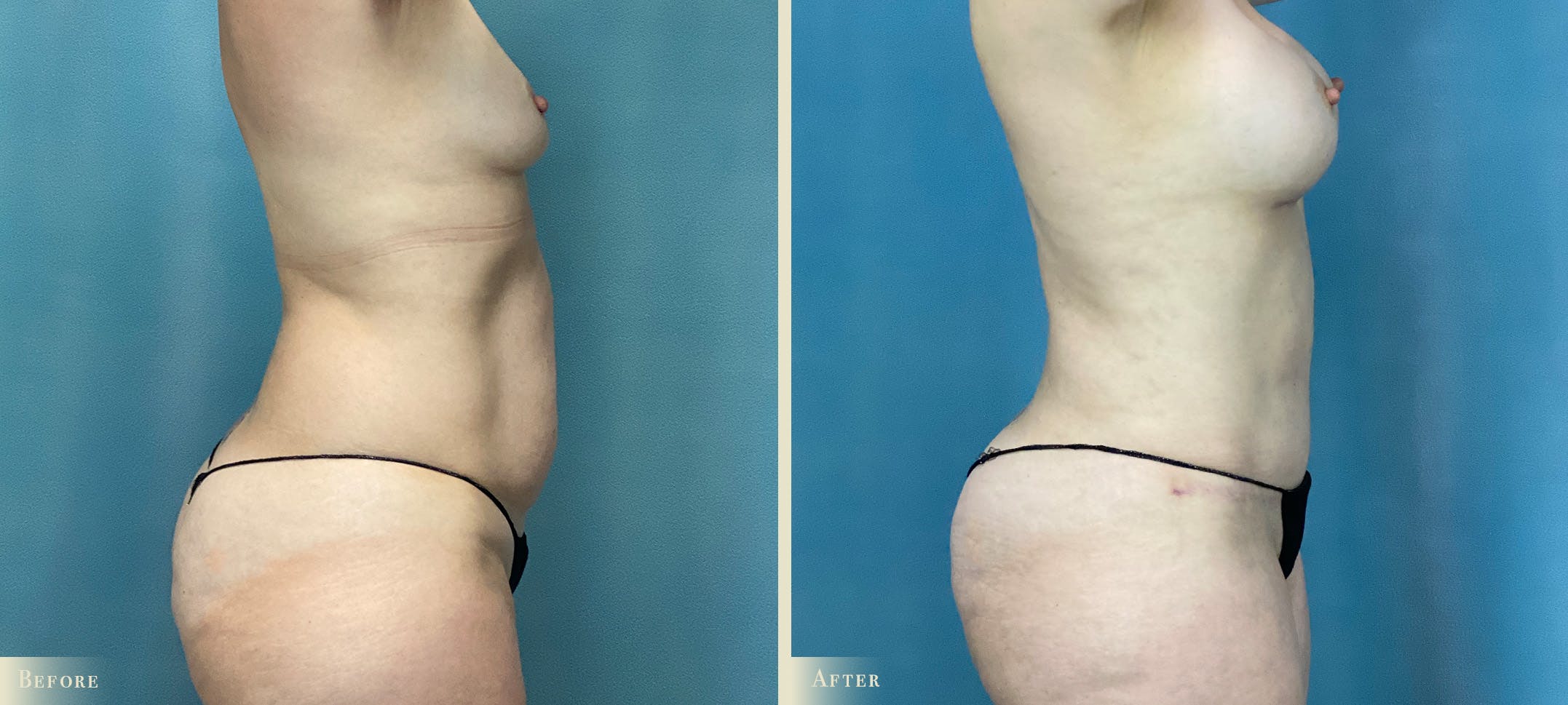 Tummy Tuck Before & After Gallery - Patient 340820 - Image 2