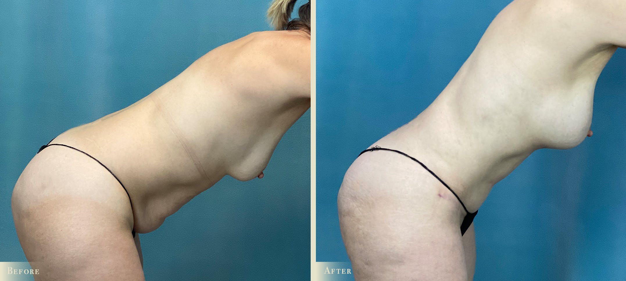 Tummy Tuck Before & After Gallery - Patient 340820 - Image 3