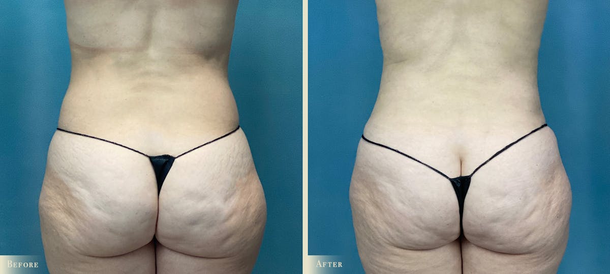 Mommy Makeover Before & After Gallery - Patient 285590 - Image 4