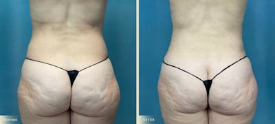 Mommy Makeover Before & After Gallery - Patient 285590 - Image 4