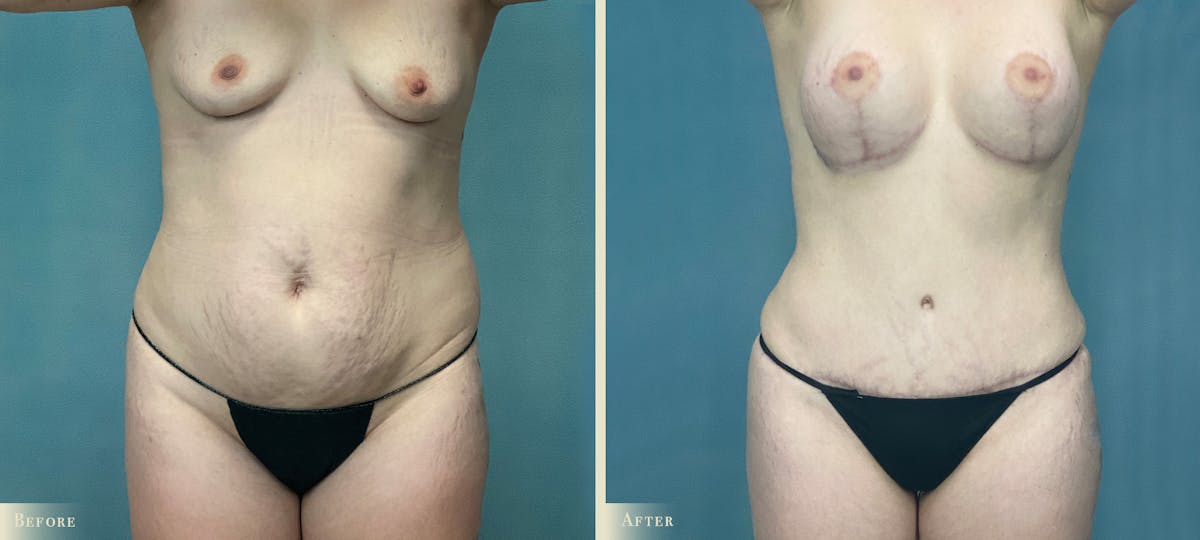 Mommy Makeover Before & After Gallery - Patient 418474 - Image 1