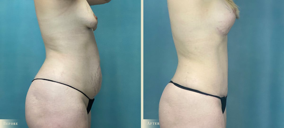Mommy Makeover Before & After Gallery - Patient 418474 - Image 2