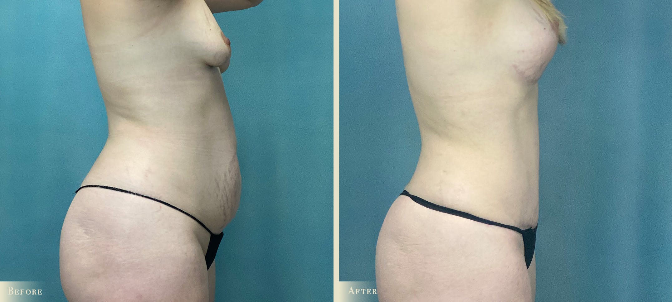 Female Liposuction Before & After Gallery - Patient 226820 - Image 2