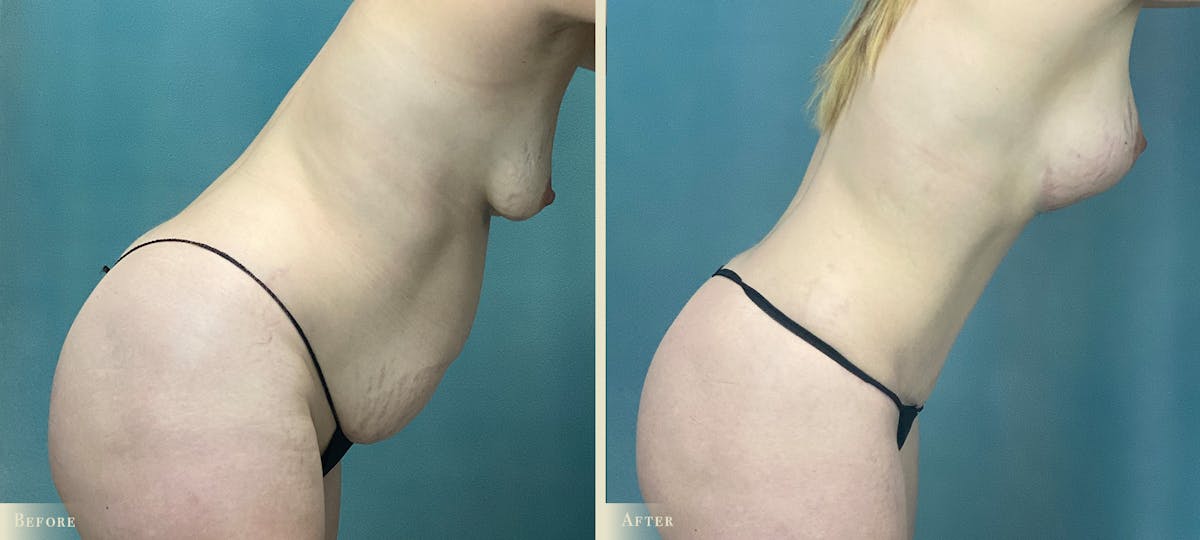Mommy Makeover Before & After Gallery - Patient 418474 - Image 3