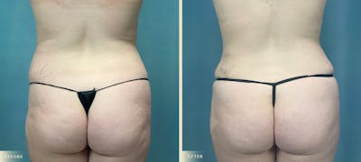 Mommy Makeover Before & After Gallery - Patient 418474 - Image 4