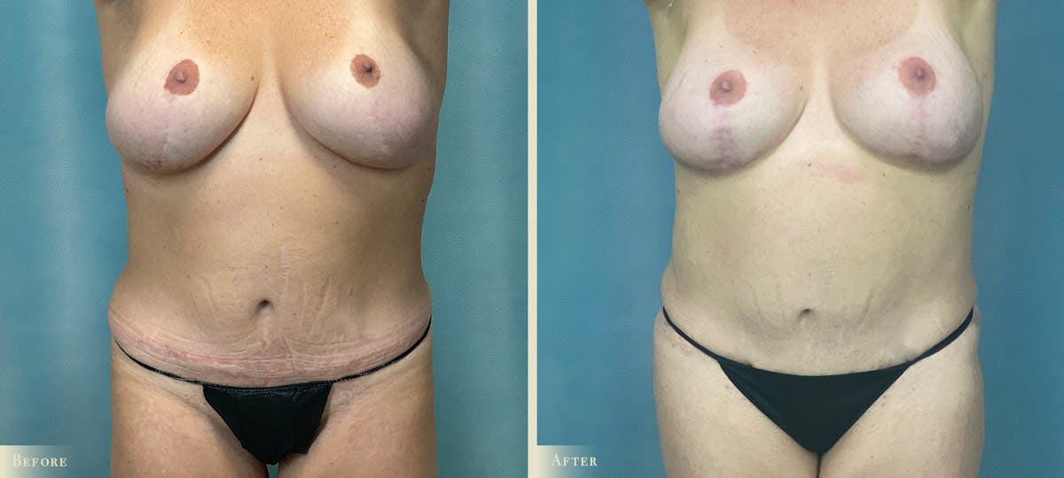 Mommy Makeover Before & After Gallery - Patient 815789 - Image 1