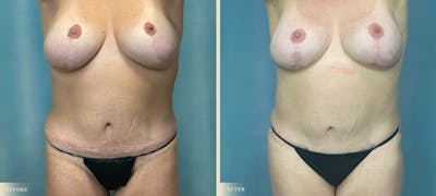 Female Liposuction Before & After Gallery - Patient 189250 - Image 1