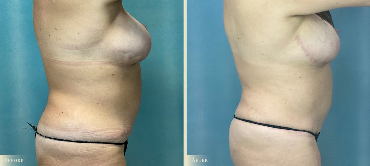 Mommy Makeover Before & After Gallery - Patient 815789 - Image 2