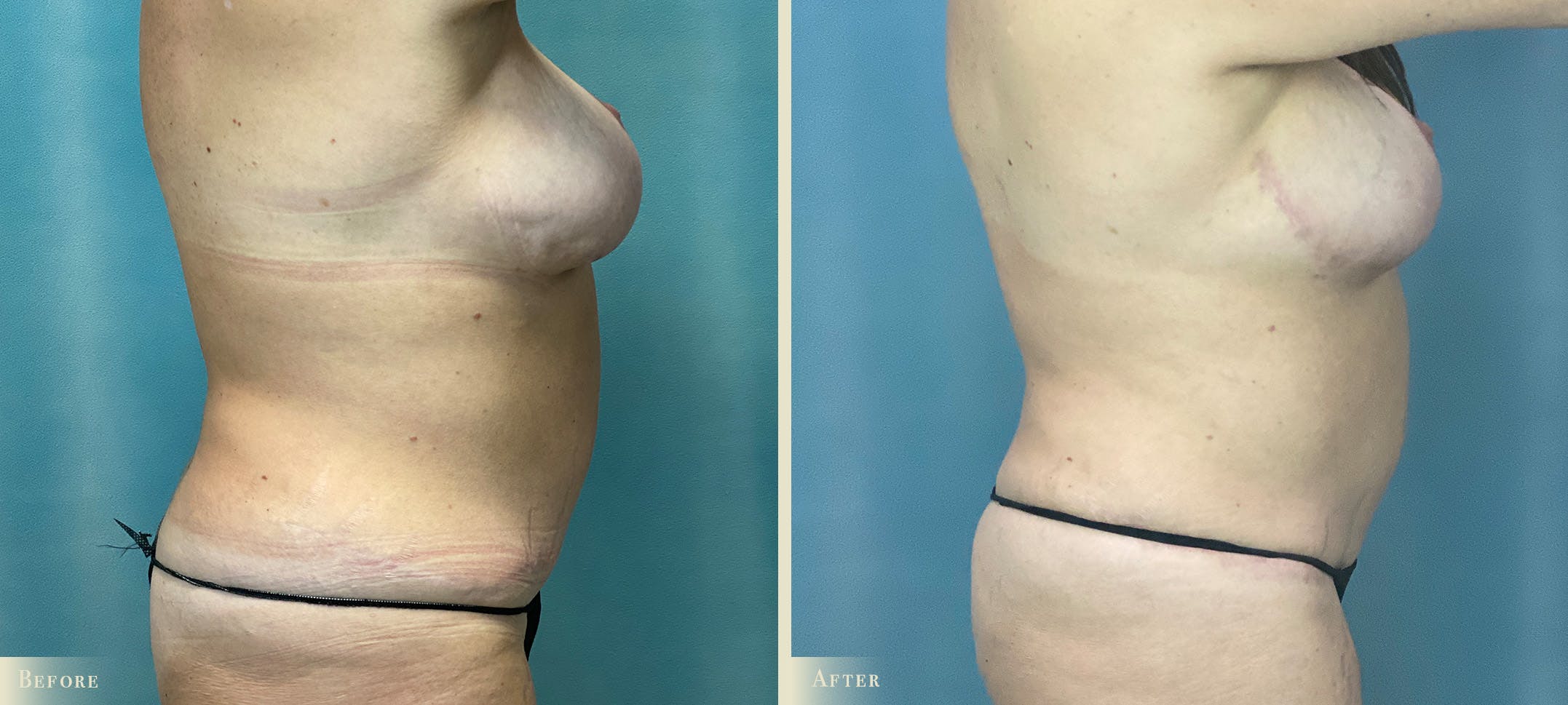 Female Liposuction Before & After Gallery - Patient 189250 - Image 2