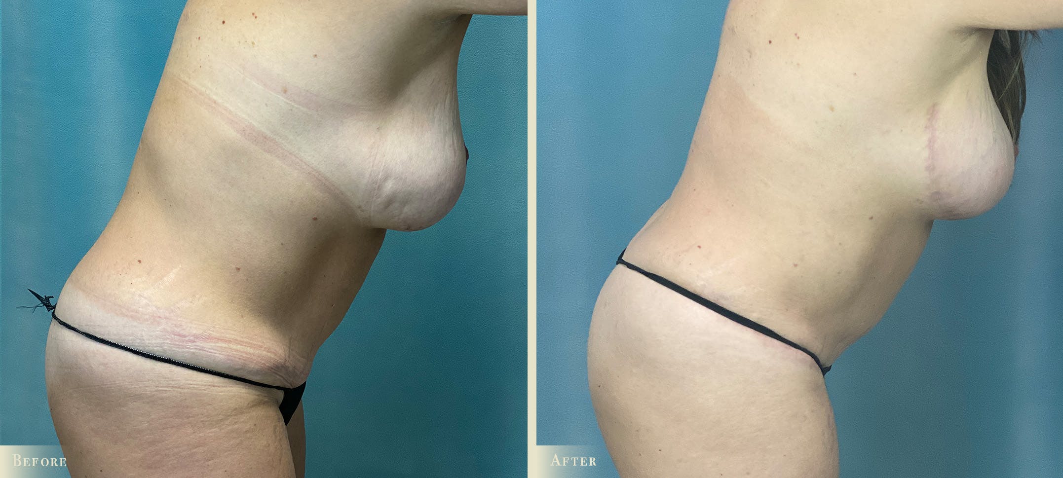 Female Liposuction Before & After Gallery - Patient 189250 - Image 3