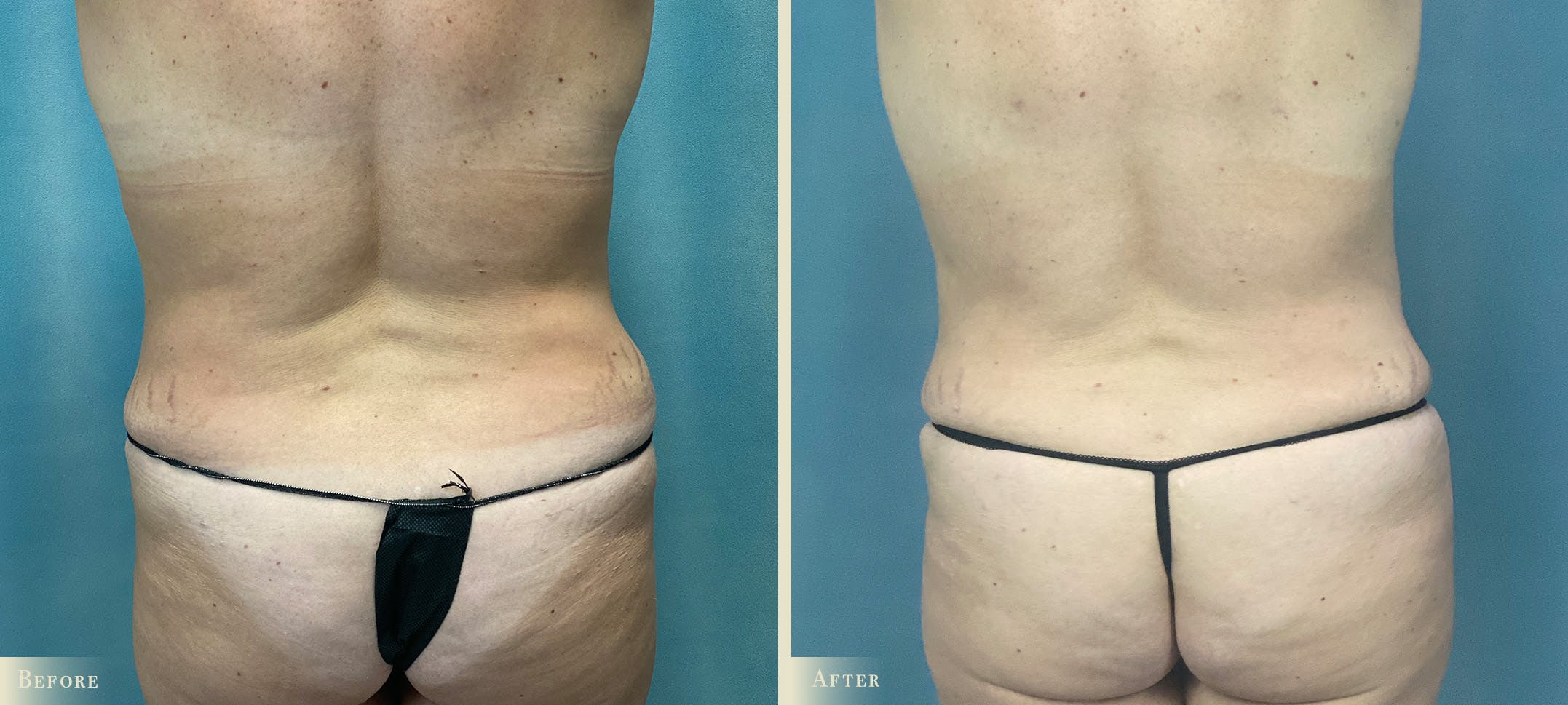 Female Liposuction Before & After Gallery - Patient 189250 - Image 4