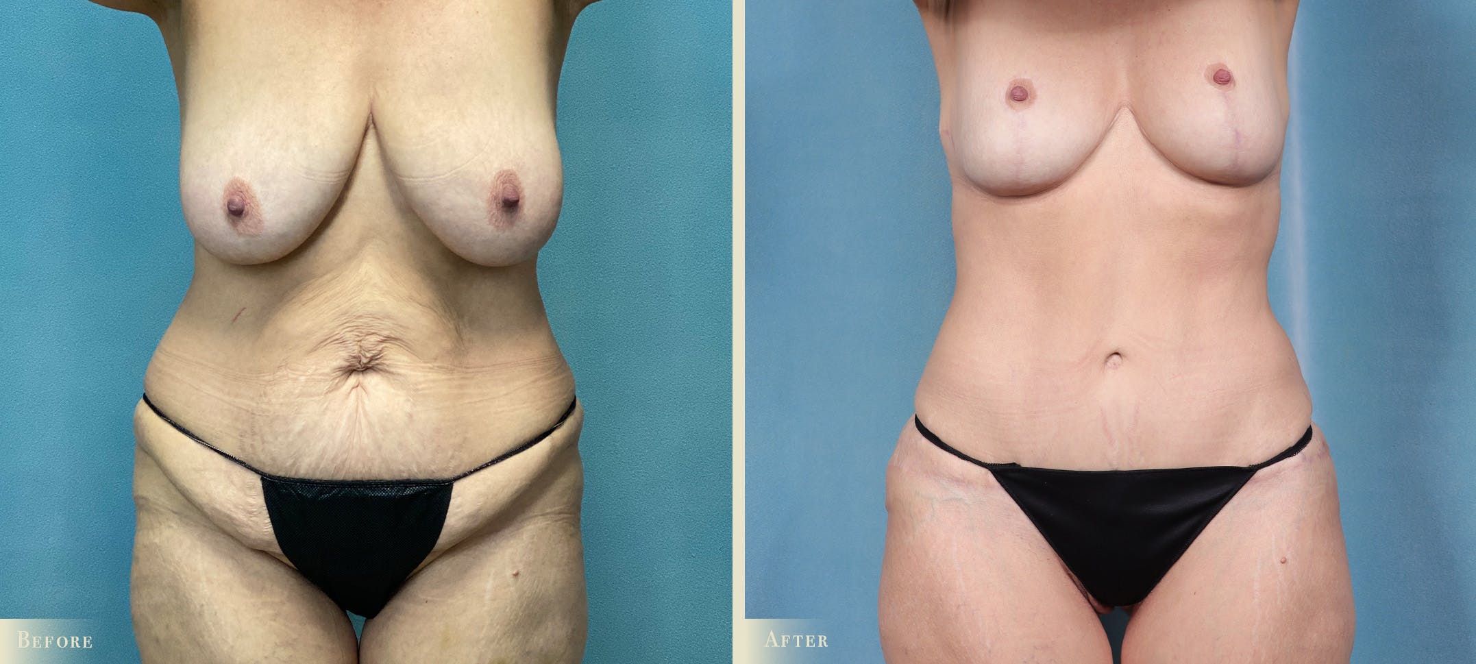 Mommy Makeover Before & After Gallery - Patient 424846 - Image 1