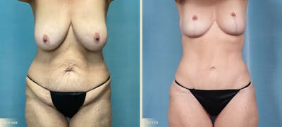 Female Liposuction Before & After Gallery - Patient 917175 - Image 1