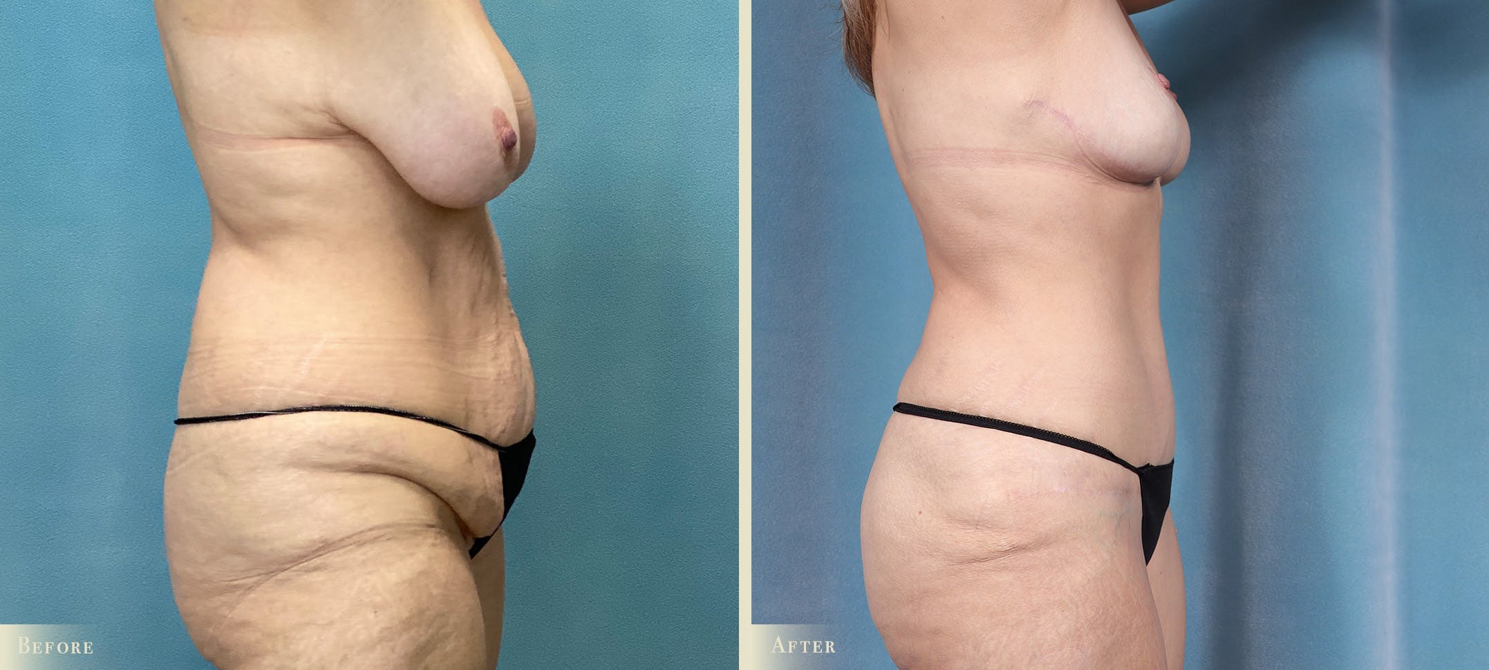 Mommy Makeover Before & After Gallery - Patient 424846 - Image 2