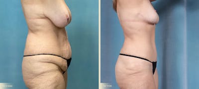 Mommy Makeover Before & After Gallery - Patient 424846 - Image 2