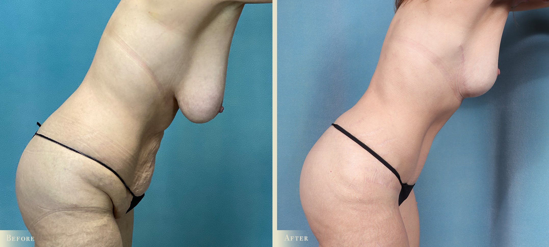 Mommy Makeover Before & After Gallery - Patient 424846 - Image 3