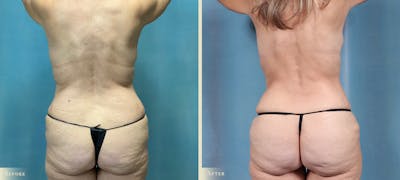 Mommy Makeover Before & After Gallery - Patient 424846 - Image 4