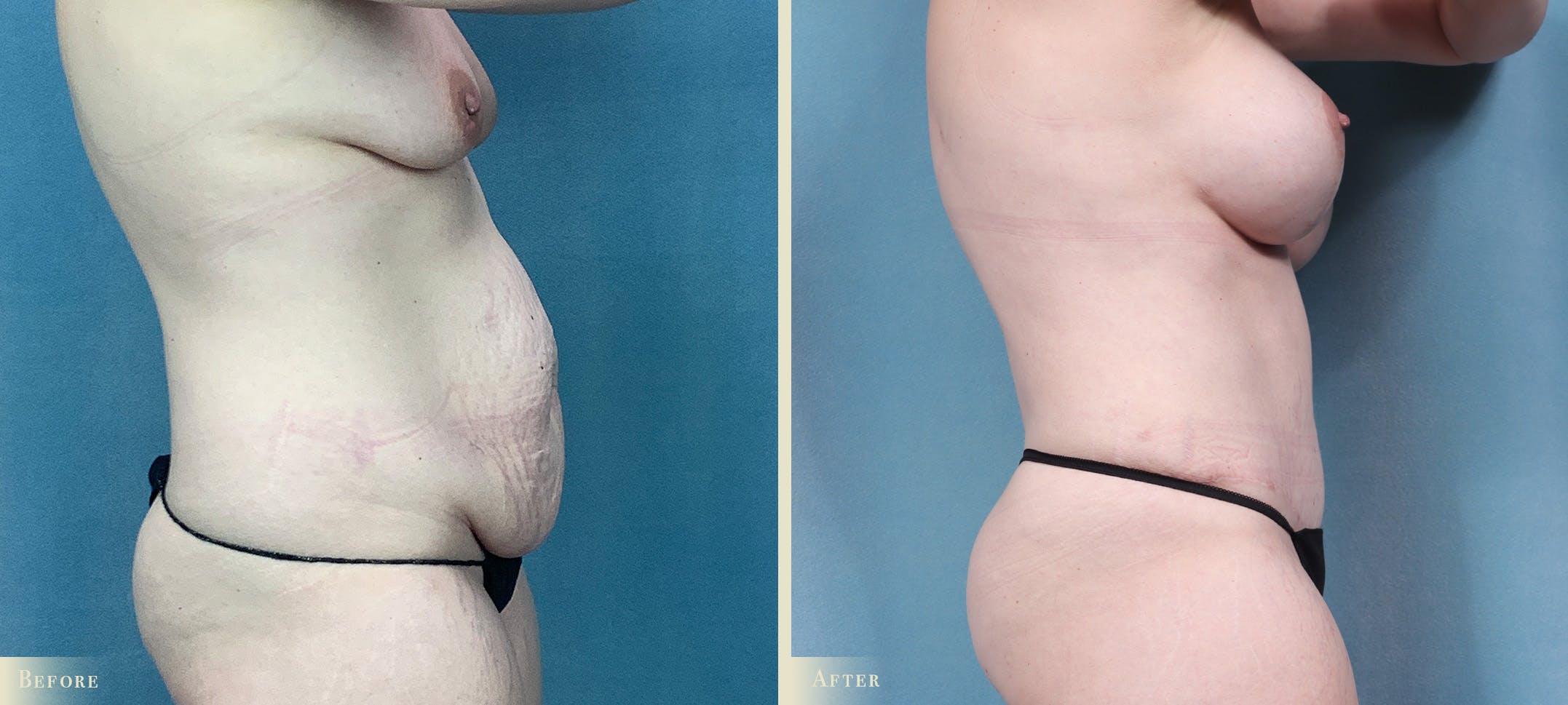 Mommy Makeover Before & After Gallery - Patient 211021 - Image 2