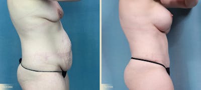 Mommy Makeover Before & After Gallery - Patient 211021 - Image 2