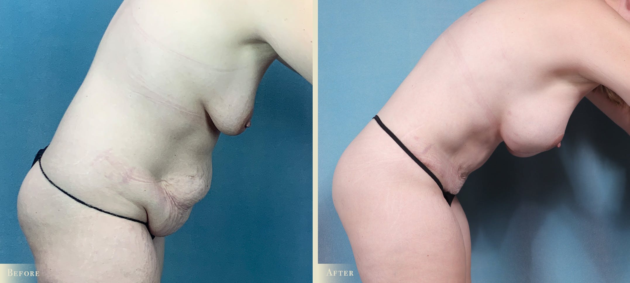 Mommy Makeover Before & After Gallery - Patient 211021 - Image 3