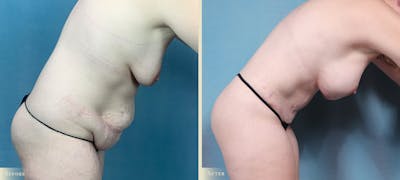 Mommy Makeover Before & After Gallery - Patient 211021 - Image 3