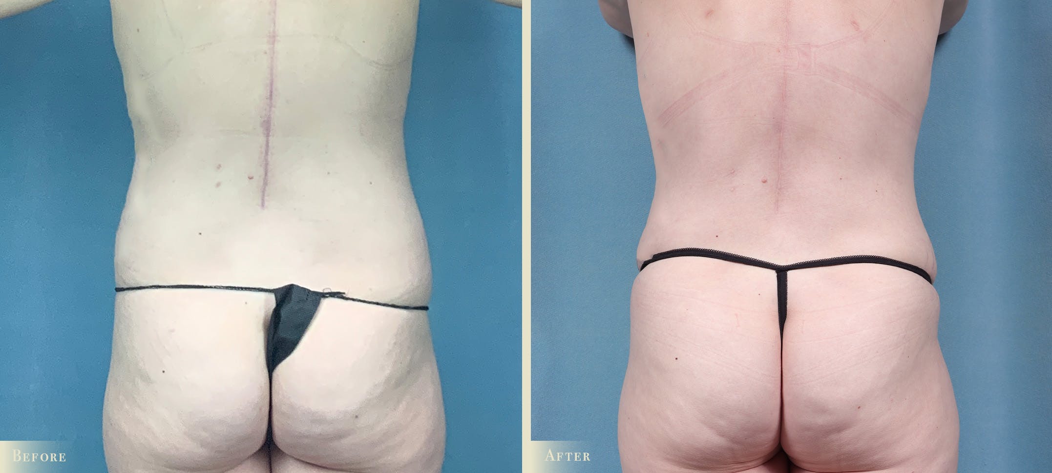 Mommy Makeover Before & After Gallery - Patient 211021 - Image 4