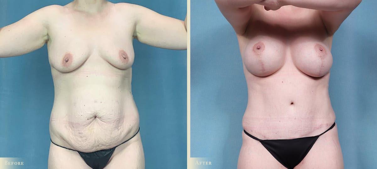 Mommy Makeover Before & After Gallery - Patient 211021 - Image 1