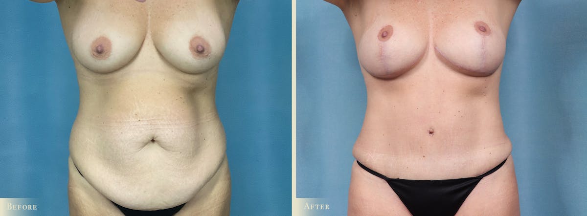 Mommy Makeover Before & After Gallery - Patient 307990 - Image 1