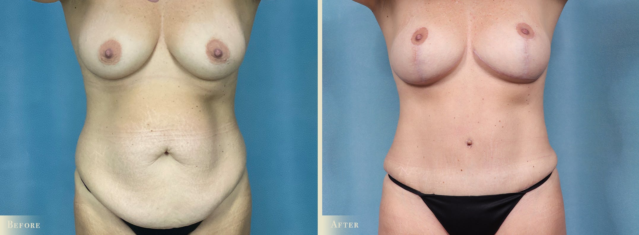 Female Liposuction Before & After Gallery - Patient 255908 - Image 1