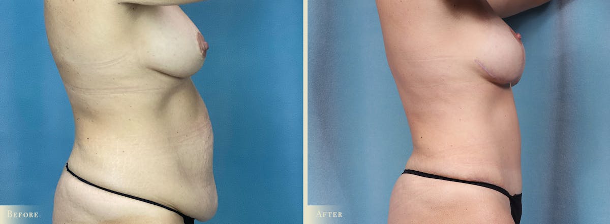 Mommy Makeover Before & After Gallery - Patient 307990 - Image 2