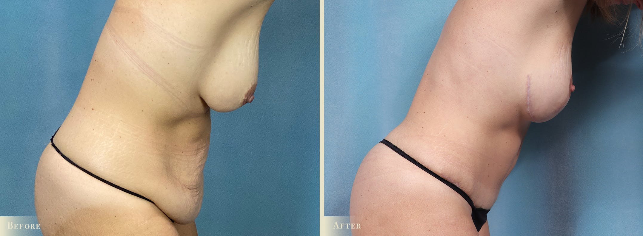 Female Liposuction Before & After Gallery - Patient 255908 - Image 3