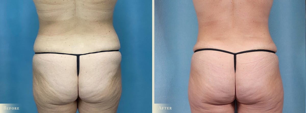 Mommy Makeover Before & After Gallery - Patient 307990 - Image 4