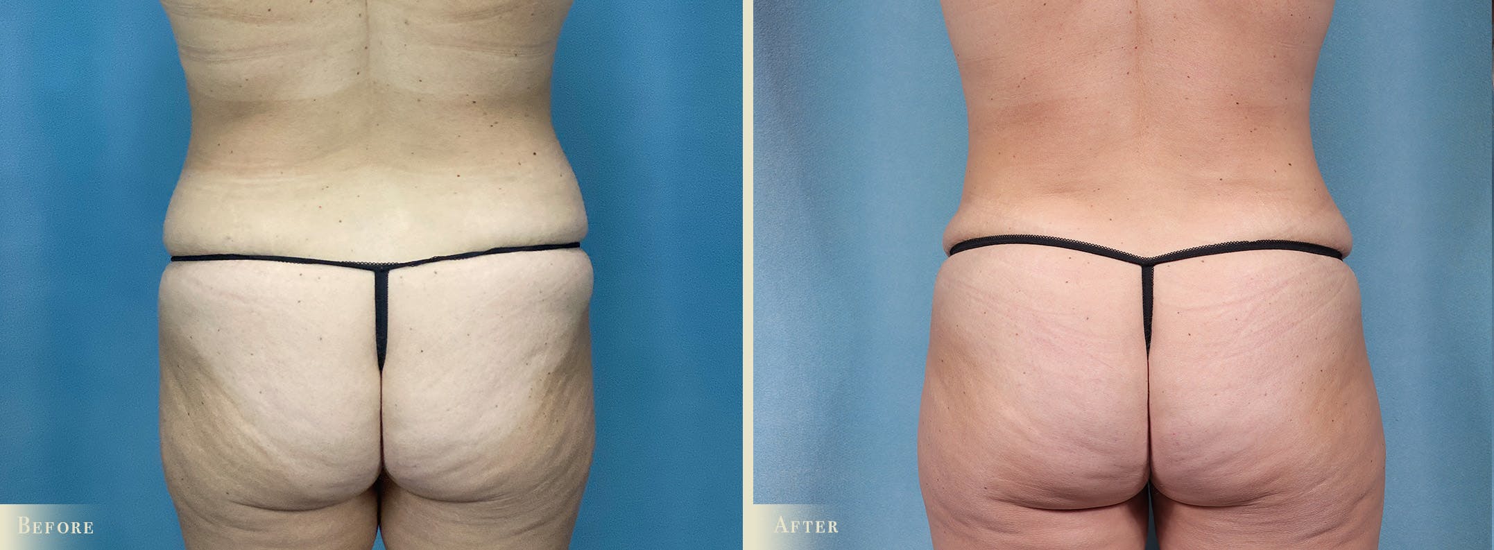 Female Liposuction Before & After Gallery - Patient 255908 - Image 4