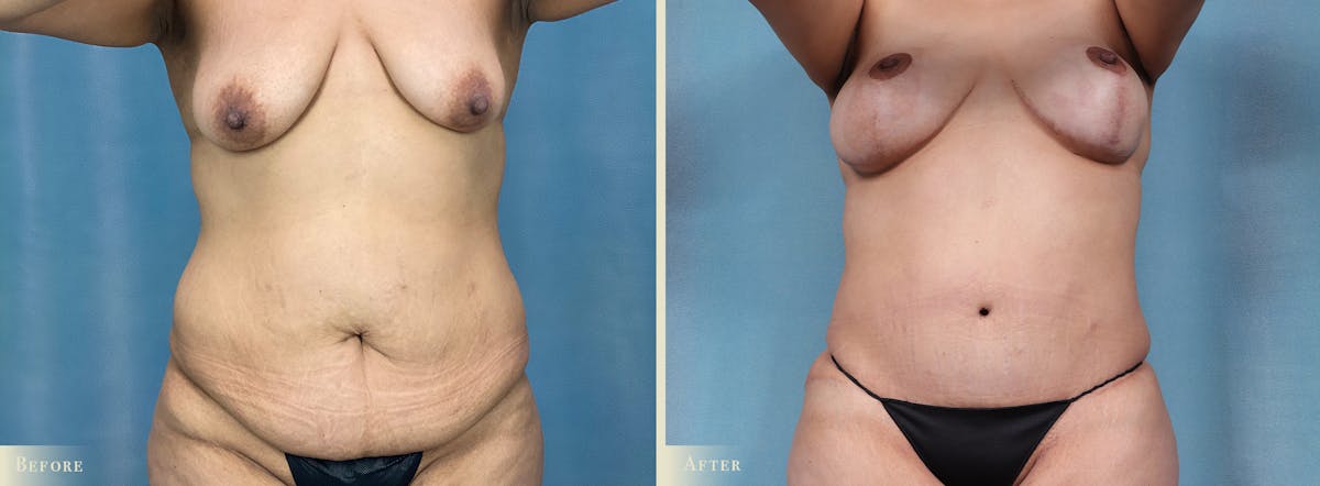 Mommy Makeover Before & After Gallery - Patient 558434 - Image 1