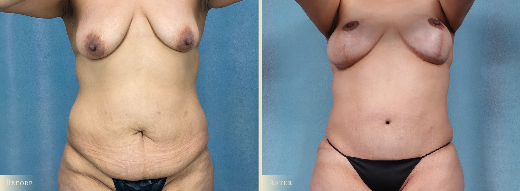 Brazilian Butt Lift Before & After Gallery - Patient 197482 - Image 2