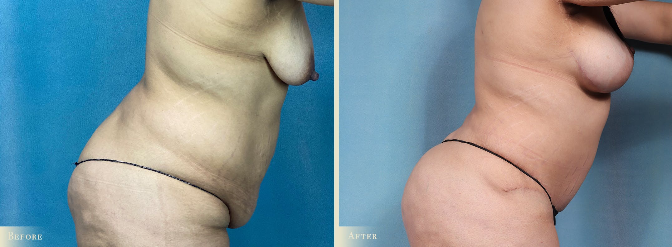 Brazilian Butt Lift Before & After Gallery - Patient 197482 - Image 3