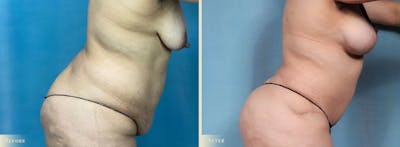 Brazilian Butt Lift Before & After Gallery - Patient 197482 - Image 3