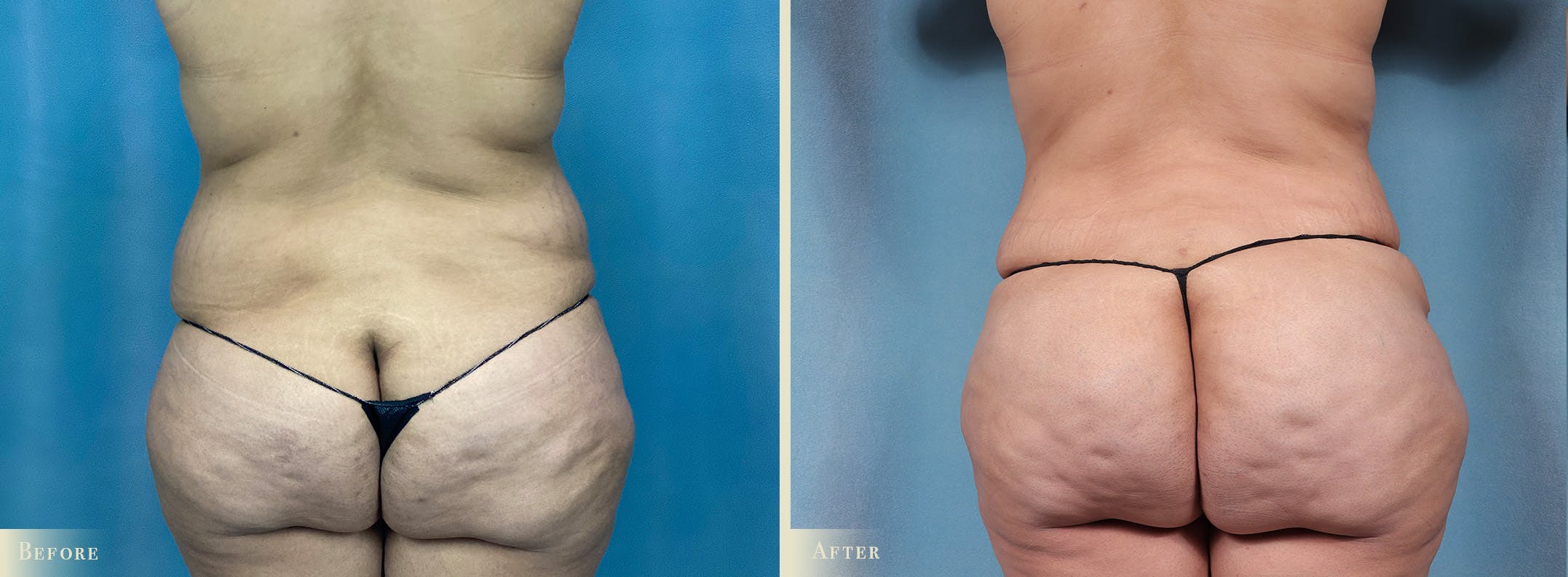 Brazilian Butt Lift Before & After Gallery - Patient 197482 - Image 1