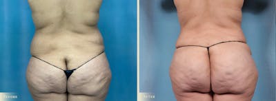 Brazilian Butt Lift Before & After Gallery - Patient 197482 - Image 1