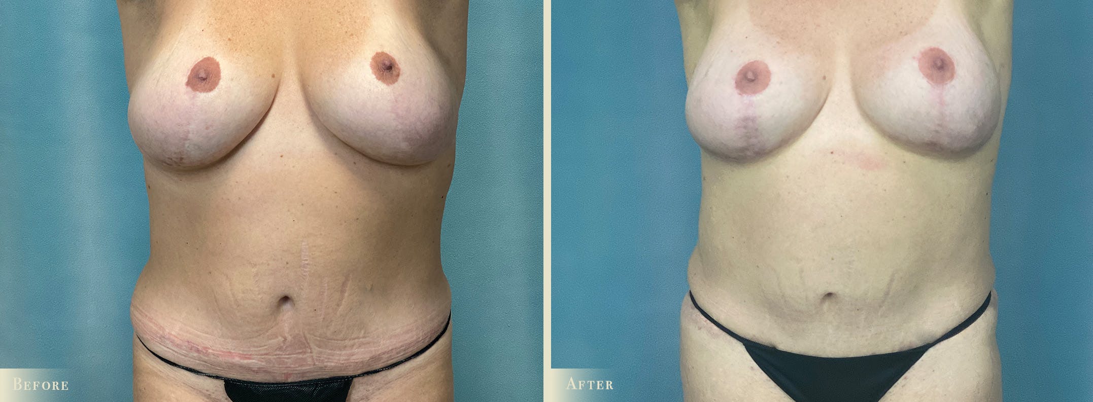 Mini Tummy Tuck Before & After Gallery - Patient 383005 - Image 1