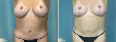Female Liposuction Before & After Gallery - Patient 237123 - Image 1